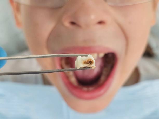 Best Emergency Dental Care for Abscessed Tooth in Alto, GA